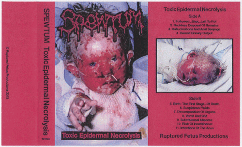 Spewtum : Toxic Epedermal Necrolysis
